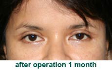 plastic-surgery-blepharoplasty